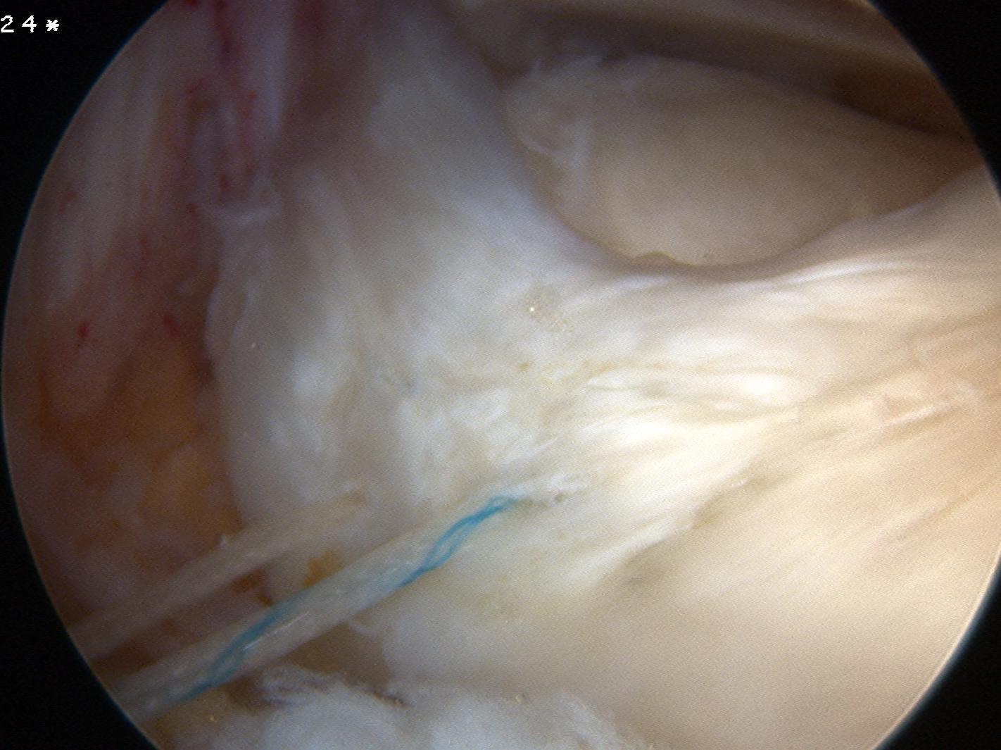 Anterior Horn Tear Sutures